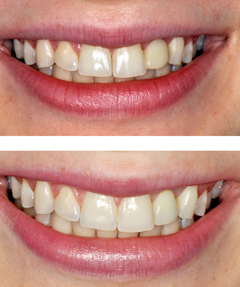 Closeup photos of female patient smiling showing smile makeover results