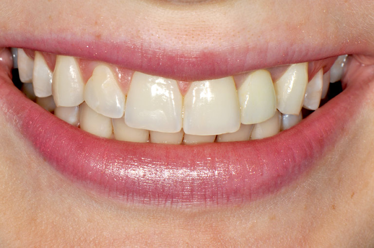 Closeup photo of female patient smiling showing teeth after smile makeover