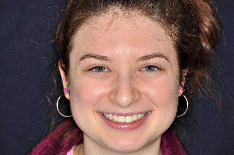 Headshot photo of female patient smiling before smile makeover