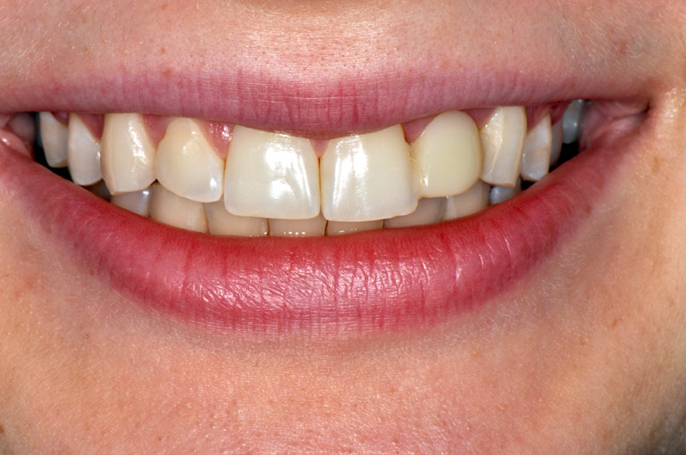 Closeup photo of female patient smiling showing teeth before smile makeover