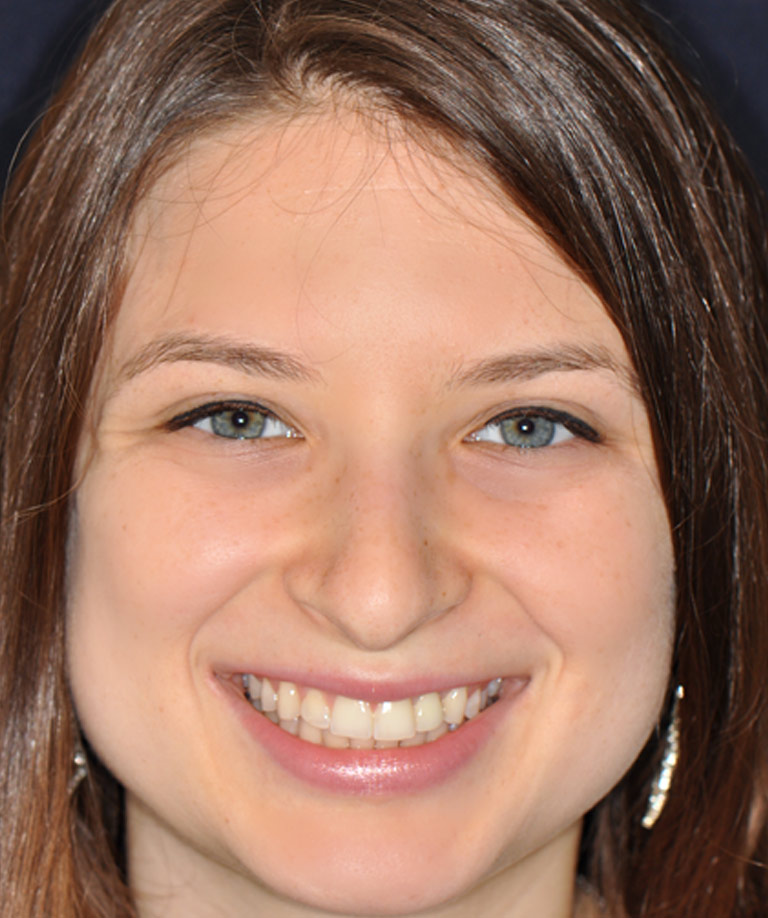 Headshot photo of female patient with blue eyes smiling showing smile makeover sults from Weiss