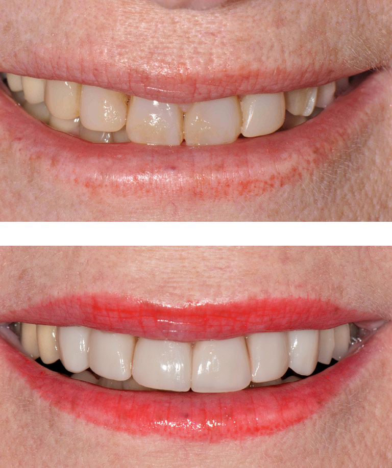Closeup photos of Arlene smiling showing smile makeover results