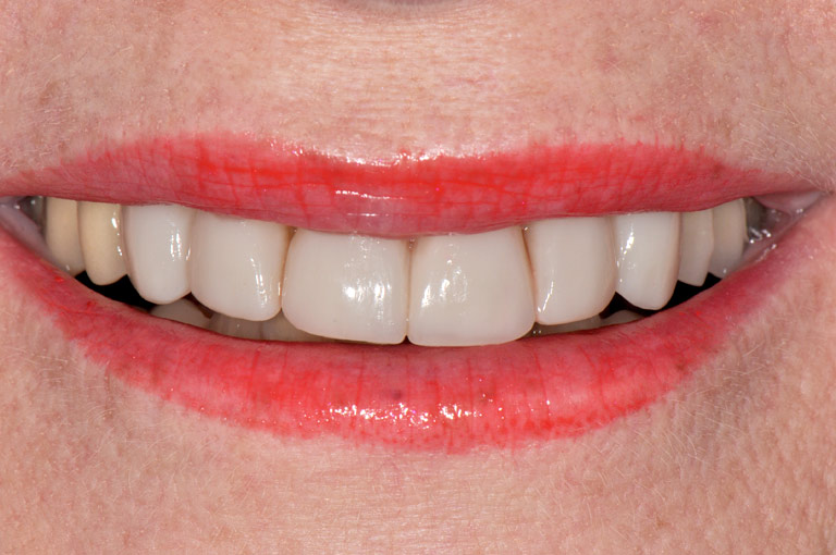 Closeup photo of Arlene smiling showing teeth after smile makeover
