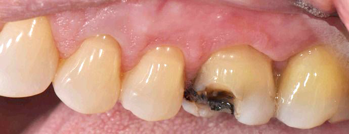 Closeup photo showing broken molar tooth before repair