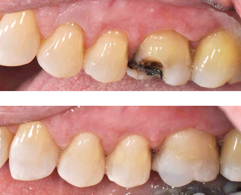 Closeup photos showing repaired broken molar before and after by Dr. Weiss