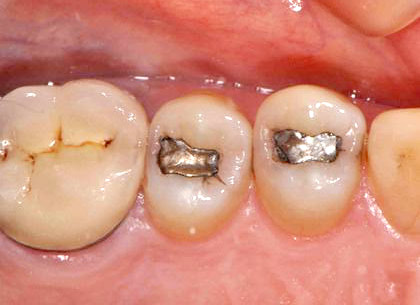 Closeup photo showing teeth with silver fillings