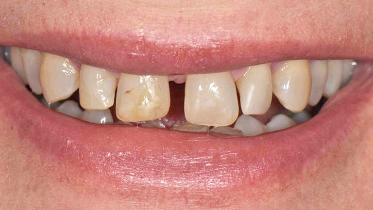 Closeup photo of man smiling with large gap in front teeth
