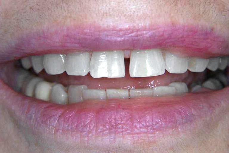 Closeup photo of woman smiling with large gap in front teeth