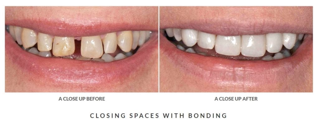 before and after dental bonding