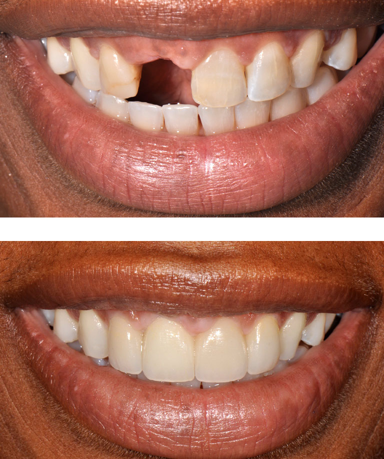 Closeup photos of young african-american woman smiling showing smile makeover results