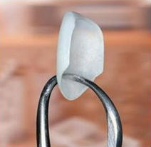 Photo of a single porcelain veneers being held by the tip of dental forceps.