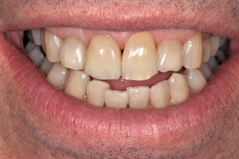 Close-up of six front teeth, showing the central incisor repaired.