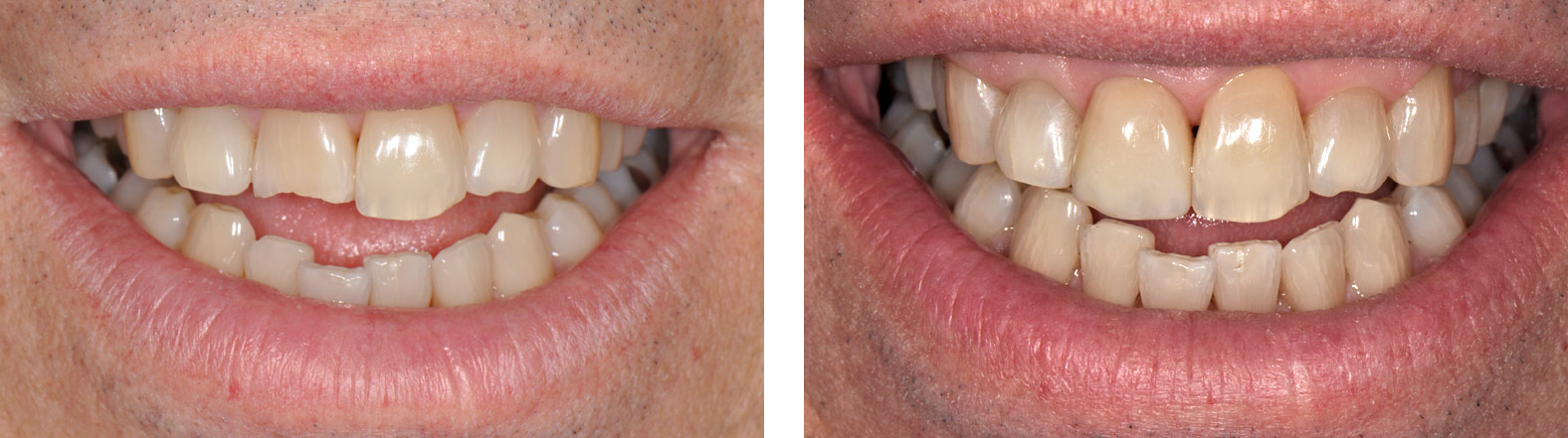 A close-up of six front teeth, showing one central incisor with a broken-off incisal edge repaired by Dr. Weiss