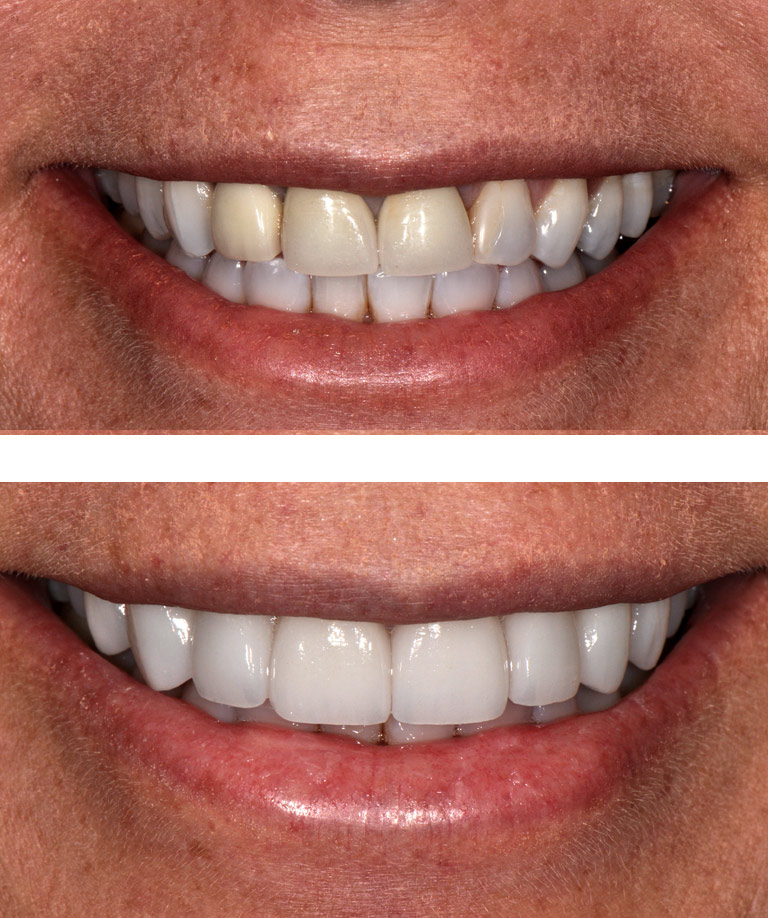 Closeup photos of female patient smiling showing smile makeover results
