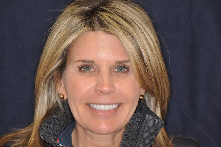 Headshot photo of blonde female patient smiling after smile makeover