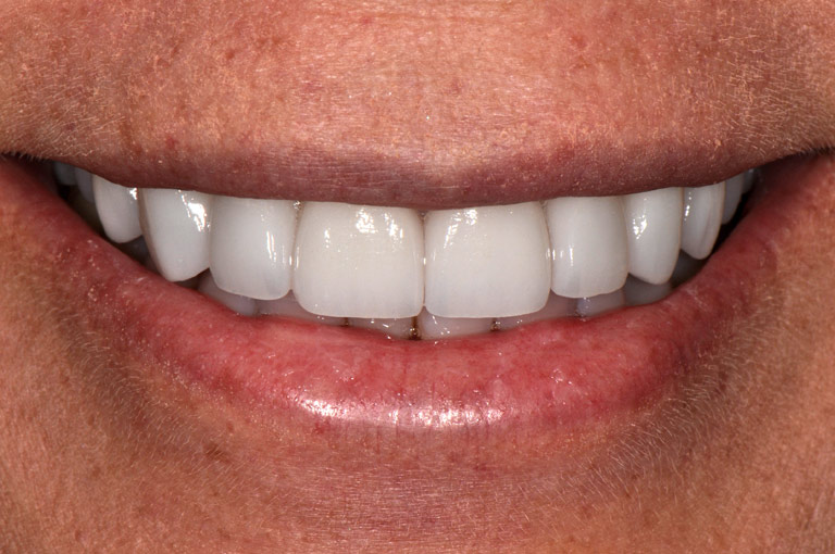 Closeup photo of female patient smiling showing teeth after smile makeover
