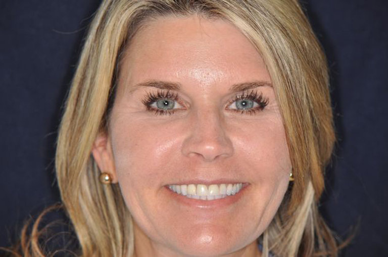 Headshot photo of blonde female patient smiling before smile makeover
