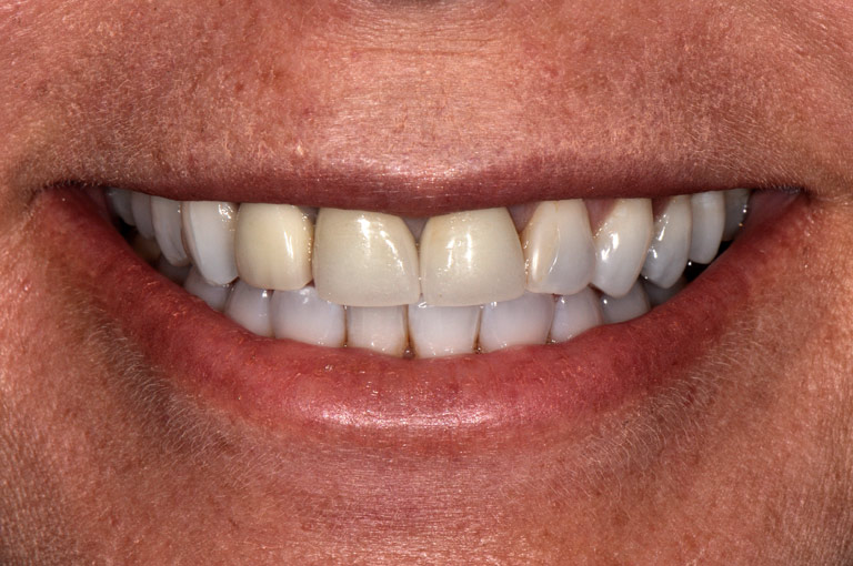 Closeup photo of female patient smiling showing teeth before smile makeover