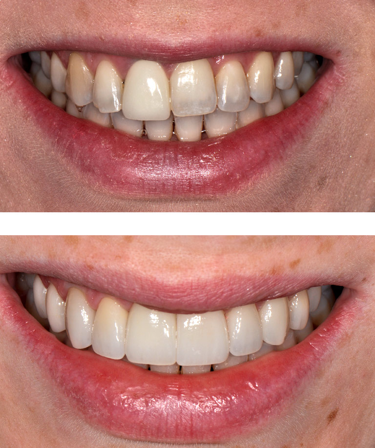 Closeup photos of female patient smiling showing smile makeover results