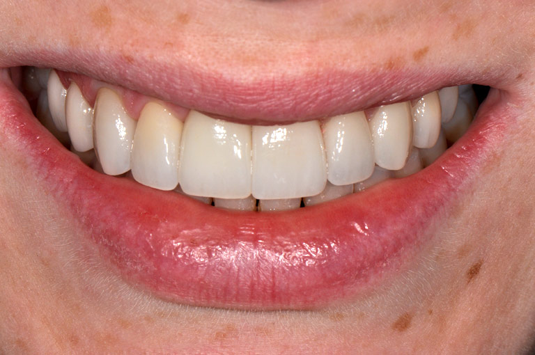 Closeup photo of female patient smiling showing teeth after smile makeover