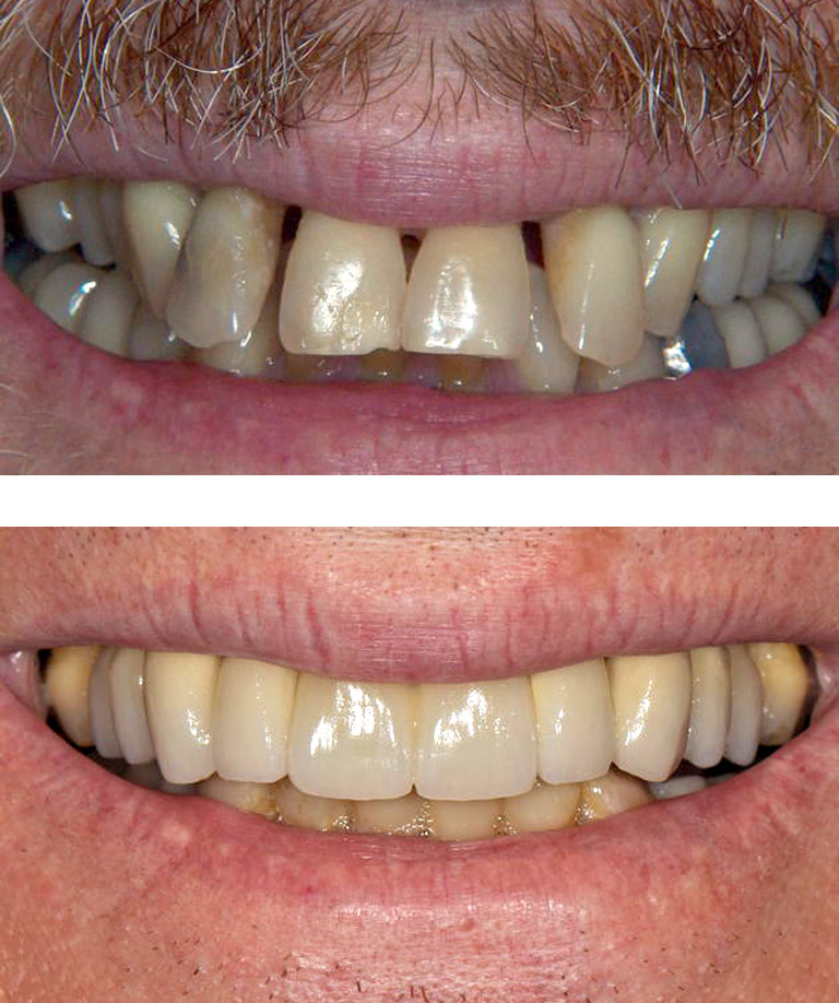 Closeup photos of man smiling showing his smile makeover results