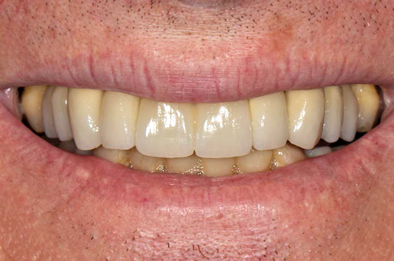 Closeup photo of man smiling showing his teeth after smile makeover