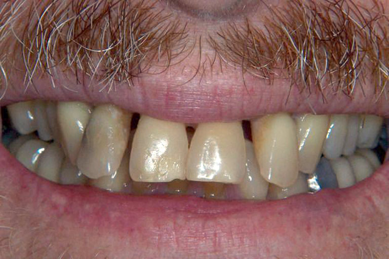 Closeup photo of man smiling showing his teeth before smile makeover