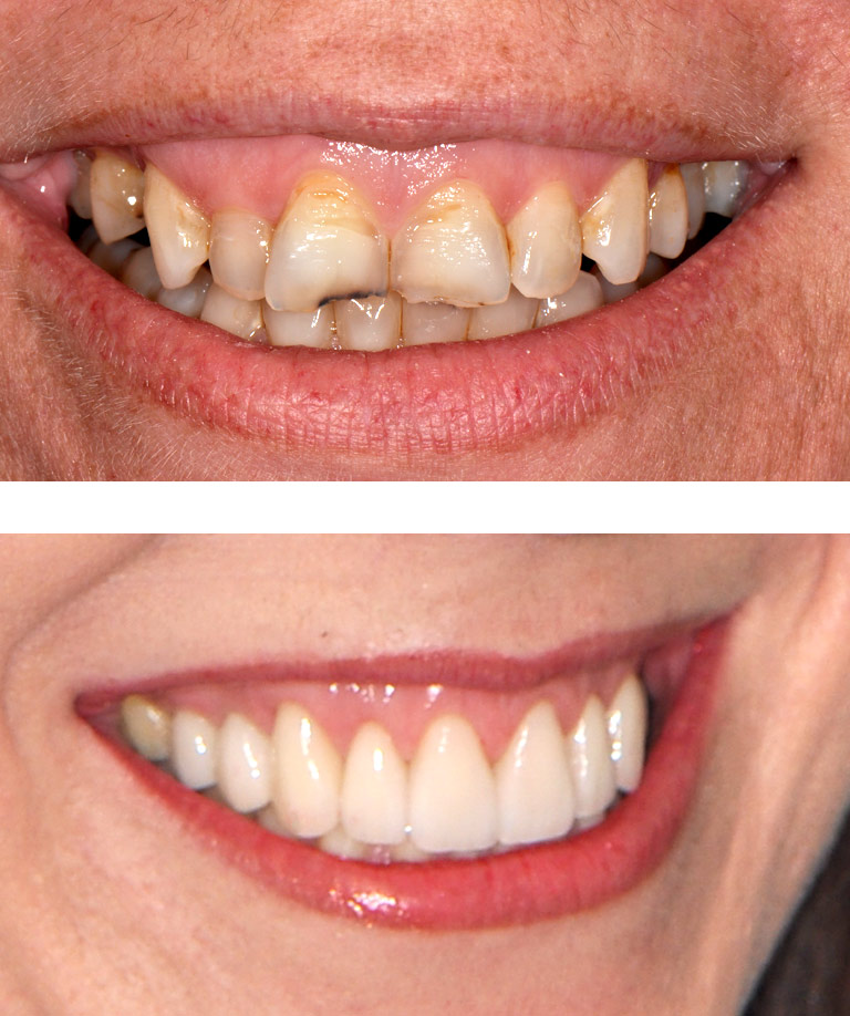Closeup photos of woman smiling showing dental bonding results
