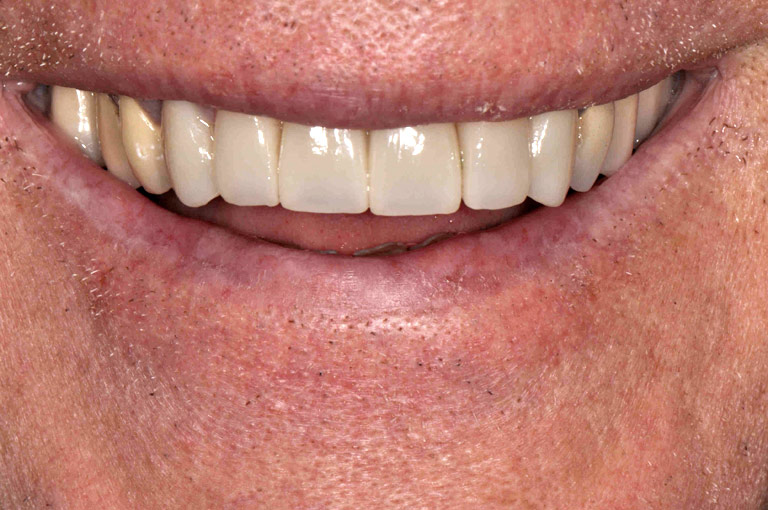 Closeup photo of older man smiling showing teeth after smile makeover