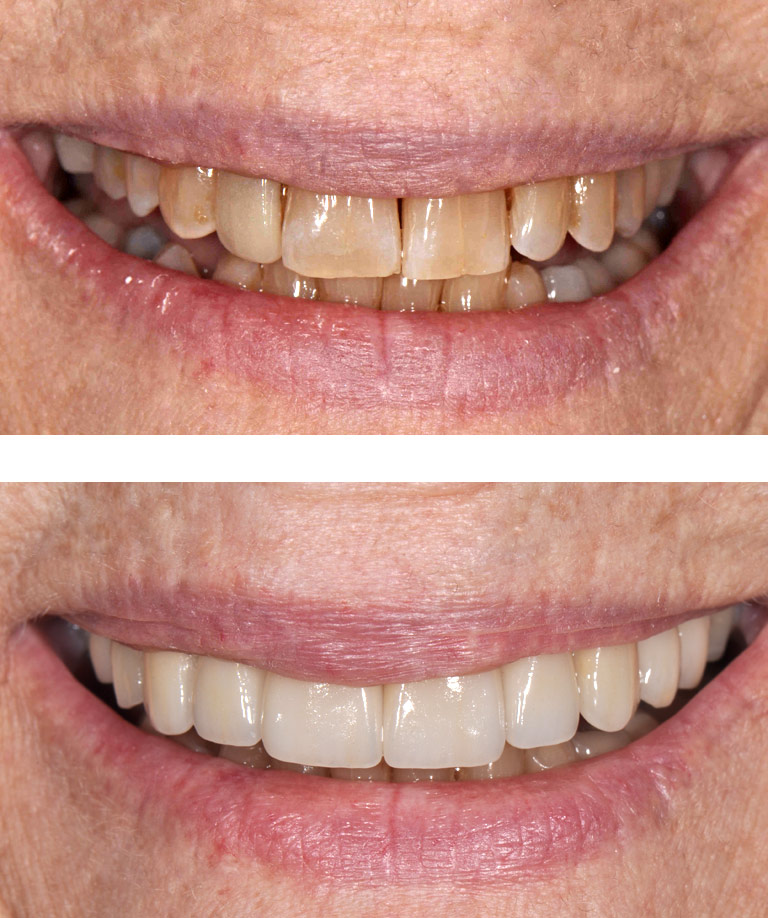 Closeup photos of older woman with glasses smiling showing smile makeover results