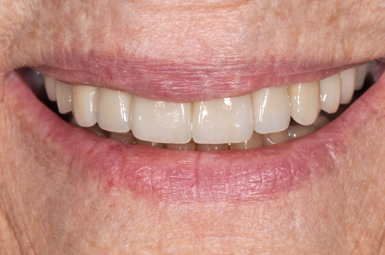 Closeup photo of older woman with glasses smiling showing teeth after smile makeover