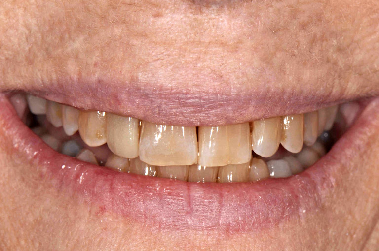 Closeup photo of older woman with glasses smiling showing teeth before smile makeover