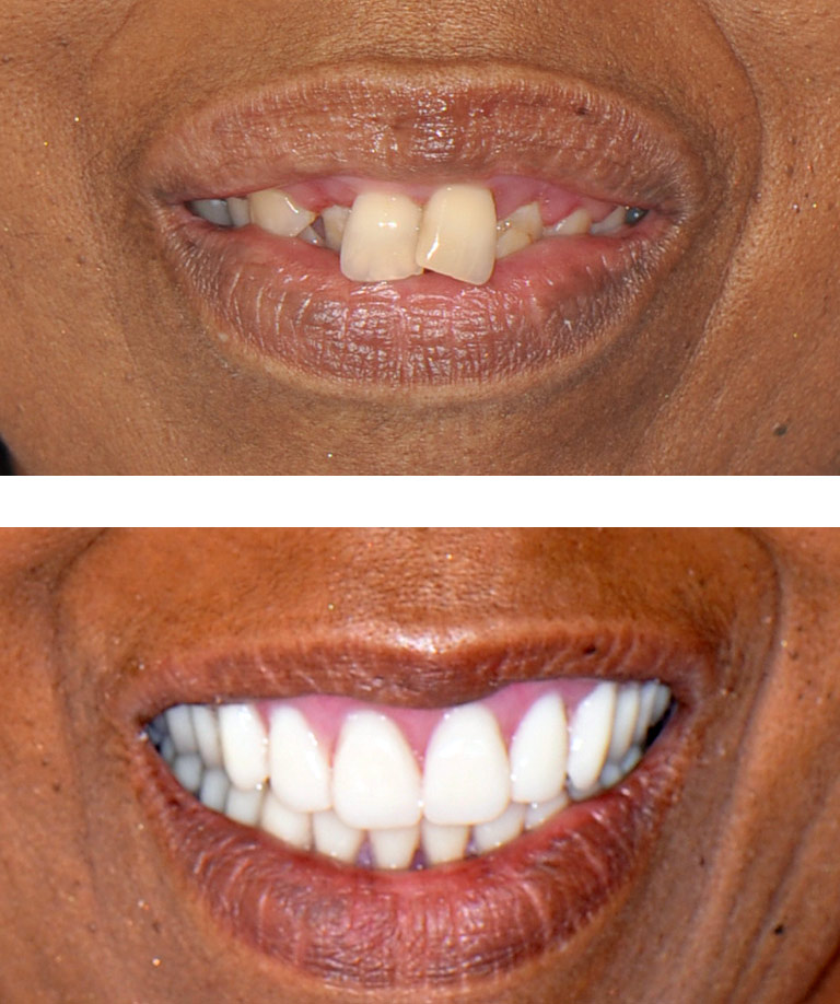 Closeup photos of african-american woman smiling showing smile makeover results