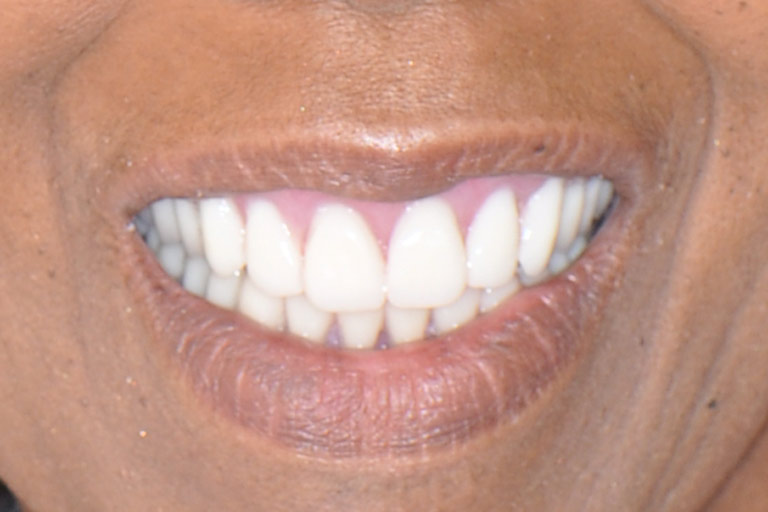 Closeup photo of african-american woman smiling after smile makeover
