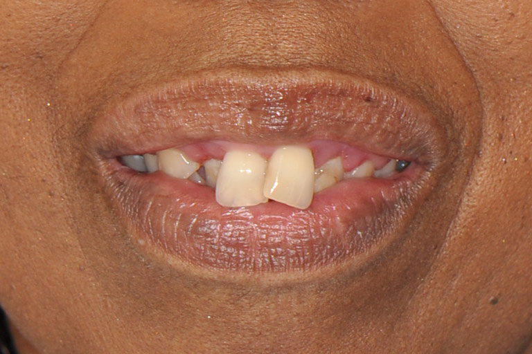 Closeup photo of african-american woman smiling before smile makeover