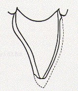 Diagram of a single tooth to illustrate the minimal amount of tooth preparation required for a porcelain veneer.