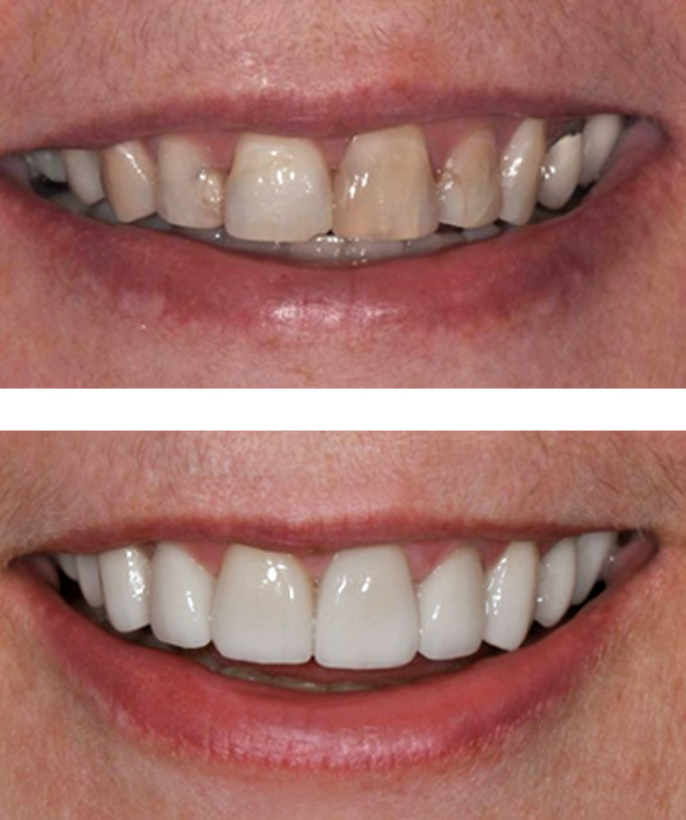 Closeup photos of woman with gray hair smiling showing smile makeover results