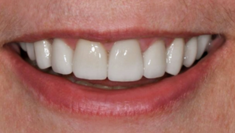 Closeup photo of woman with gray hair smiling showing teeth after smile makeover