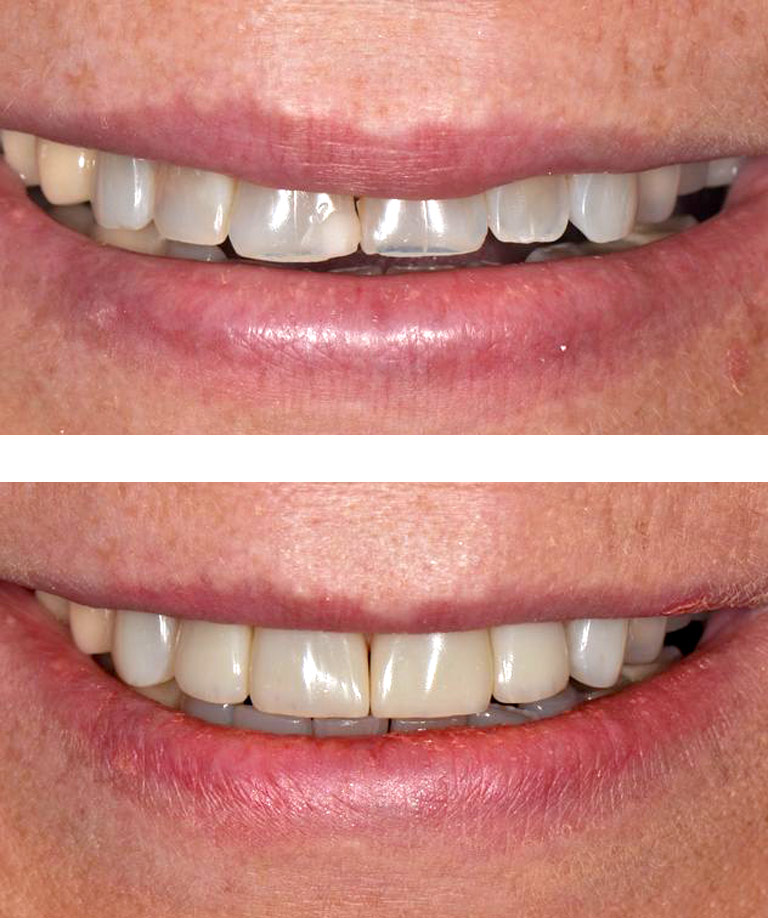 Closeup photo of short red-haired woman smiling showing smile makeover results
