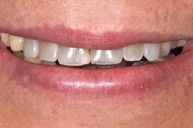 Closeup photo of short red-haired woman smiling before smile makeover