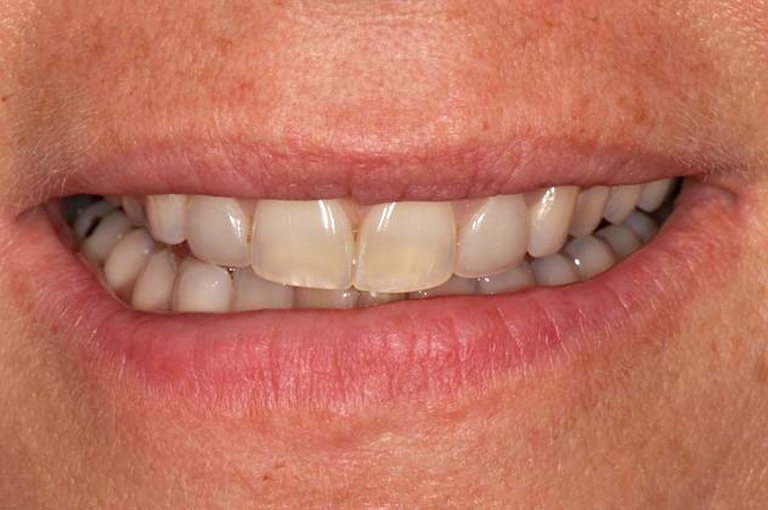 Closeup photo of middle-aged blonde woman smiling before smile makeover
