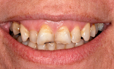 Dental crowns before photo of teeth that are yellow, uneven, and damaged. This patient's teeth were restored by Dr. Michael Weiss of Jenkintown, PA, near Philadelphia.