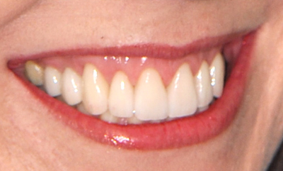 After dental crowns photo of a patient whose broken and worn teeth were restored by accredited cosmetic dentist Dr. Michael Weiss in Jenkintown, PA, near Philadephia.