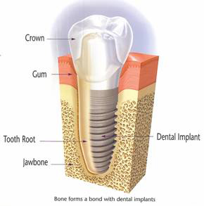 A diagram of a dental implant