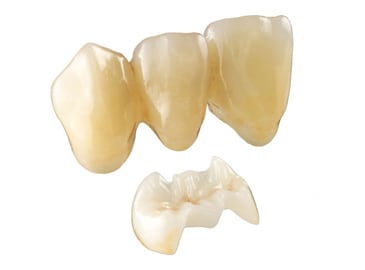 Photo of three e.max crowns joined for a dental bridge, and an overlay beneath them.