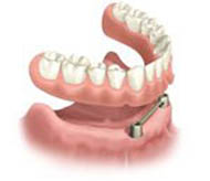Diagram of a bar-retained implant overdenture, available from Philadelphia dentist Dr. Michael Weiss.