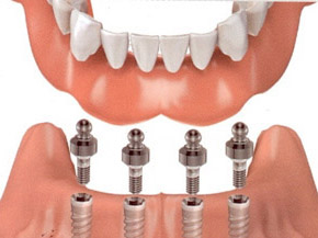 Diagram of a fixed implant overdenture with the denture hovering over four dental implants.