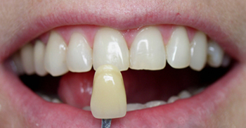 After teeth whitening close-up photo of a patient's teeth with a new dental tooth shade held up to his teeth; for information on Zoom whitening from Philadelphia dentist Dr. Michael Weiss.