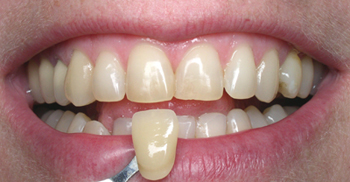 Before teeth whitening close-up photo of a patient's teeth with a dental tooth shade held up to his teeth; for information on Zoom whitening from Philadelphia dentist Dr. Michael Weiss.
