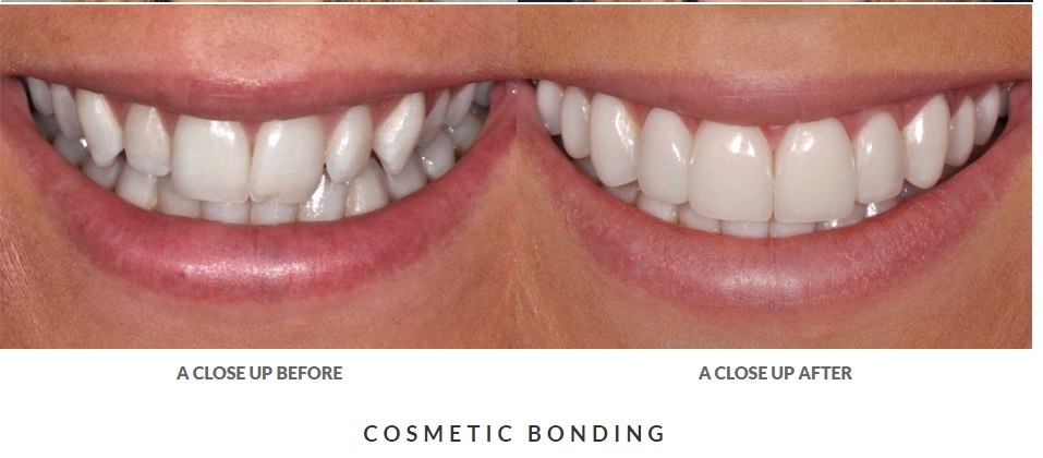 before and after dental bonding